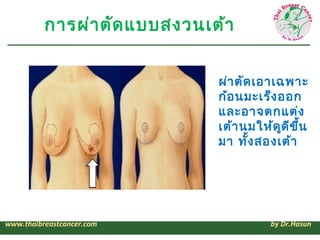 การผ่า ตัด แบบสงวนเต้า


                              ผ่า ตัด เอาเฉพาะ
                              ก้อ นมะเร็ง ออก
                              และอาจตกแต่ง
                              เต้า นมให้ด ูด ข ึ้น
                                             ี
                              มา ทัง สองเต้า
                                     ้




www.thaibreastcancer.com                 by Dr.Hasun
 