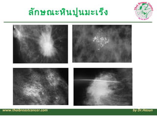 ลัก ษณะหิน ปูน มะเร็ง




www.thaibreastcancer.com             by Dr.Hasun
 