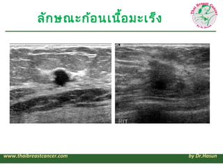 ลัก ษณะก้อ นเนื้อ มะเร็ง




www.thaibreastcancer.com               by Dr.Hasun
 