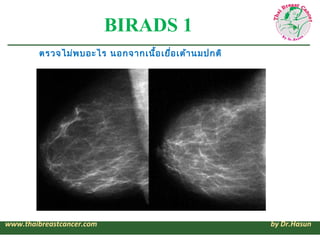 BIRADS 1
        ตรวจไม่พ บอะไร นอกจากเนื้อ เยือ เต้า นมปกติ
                                      ่




www.thaibreastcan...