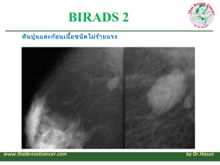BIRADS 2
       หิน ปูน และก้อ นเนื้อ ชนิด ไม่ร ้า ยแรง




www.thaibreastcancer.com                         by Dr.Hasun
 