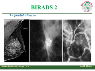 BIRADS 2
       หิน ปูน ชนิด ไม่ร ้า ยแรง




www.thaibreastcancer.com              by Dr.Hasun
 