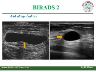 BIRADS 2
       ซีส ต์ หรือ ถุง นำ้า เต้า นม




www.thaibreastcancer.com                 by Dr.Hasun
 