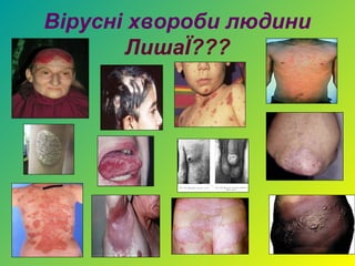 Вірусні хвороби людини
       ЛишаЇ???
 
