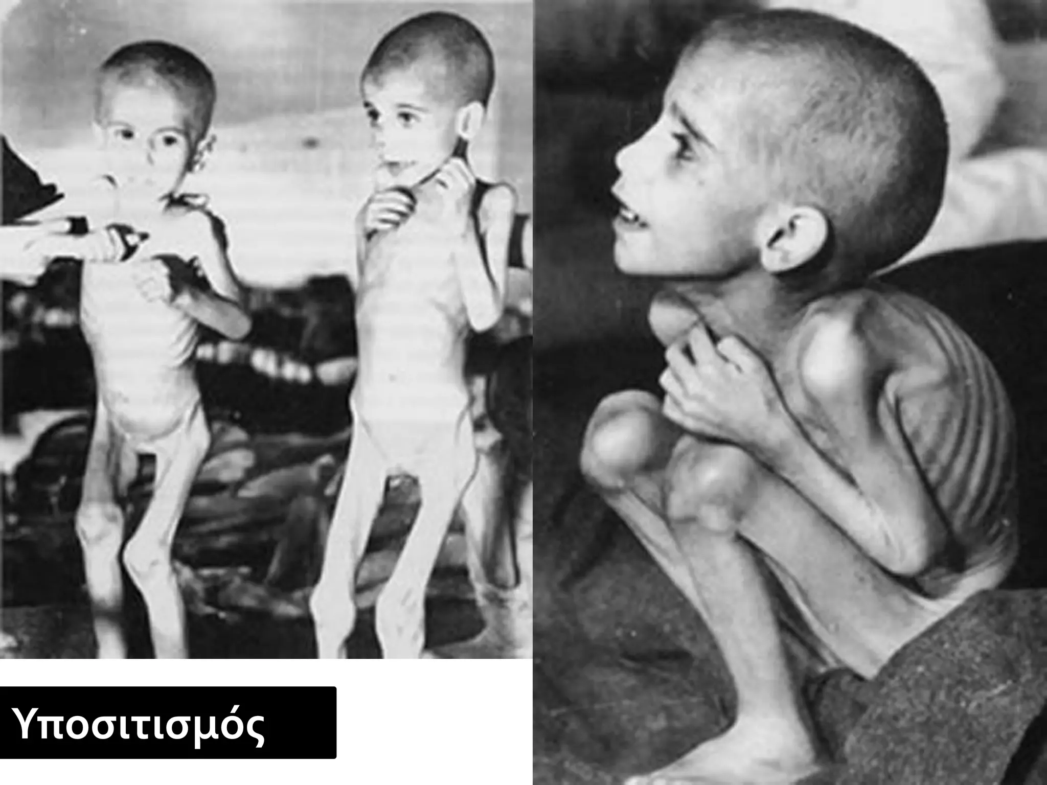 Υποσιτισμός
 