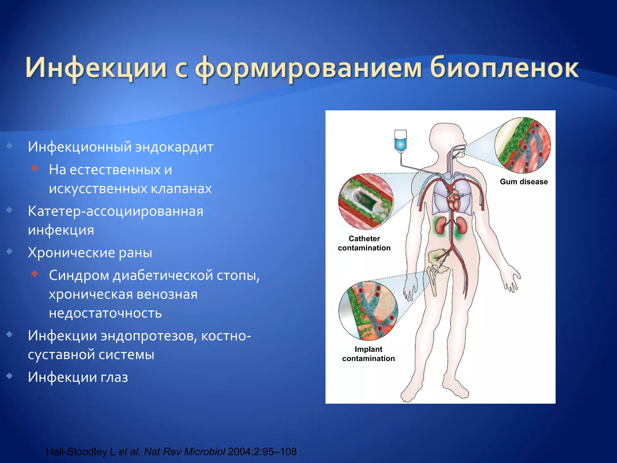    Инфекционный эндокардит
     На естественных и
                                                                                Gum disease
       искусственных клапанах
   Катетер-ассоциированная
    инфекция                                                     Catheter
   Хронические раны                                           contamination


     Синдром диабетической стопы,
       хроническая венозная
       недостаточность
   Инфекции эндопротезов, костно-
    суставной системы                                              Implant
                                                                contamination

   Инфекции глаз



      Hall-Stoodley L et al. Nat Rev Microbiol 2004;2:95–108
 