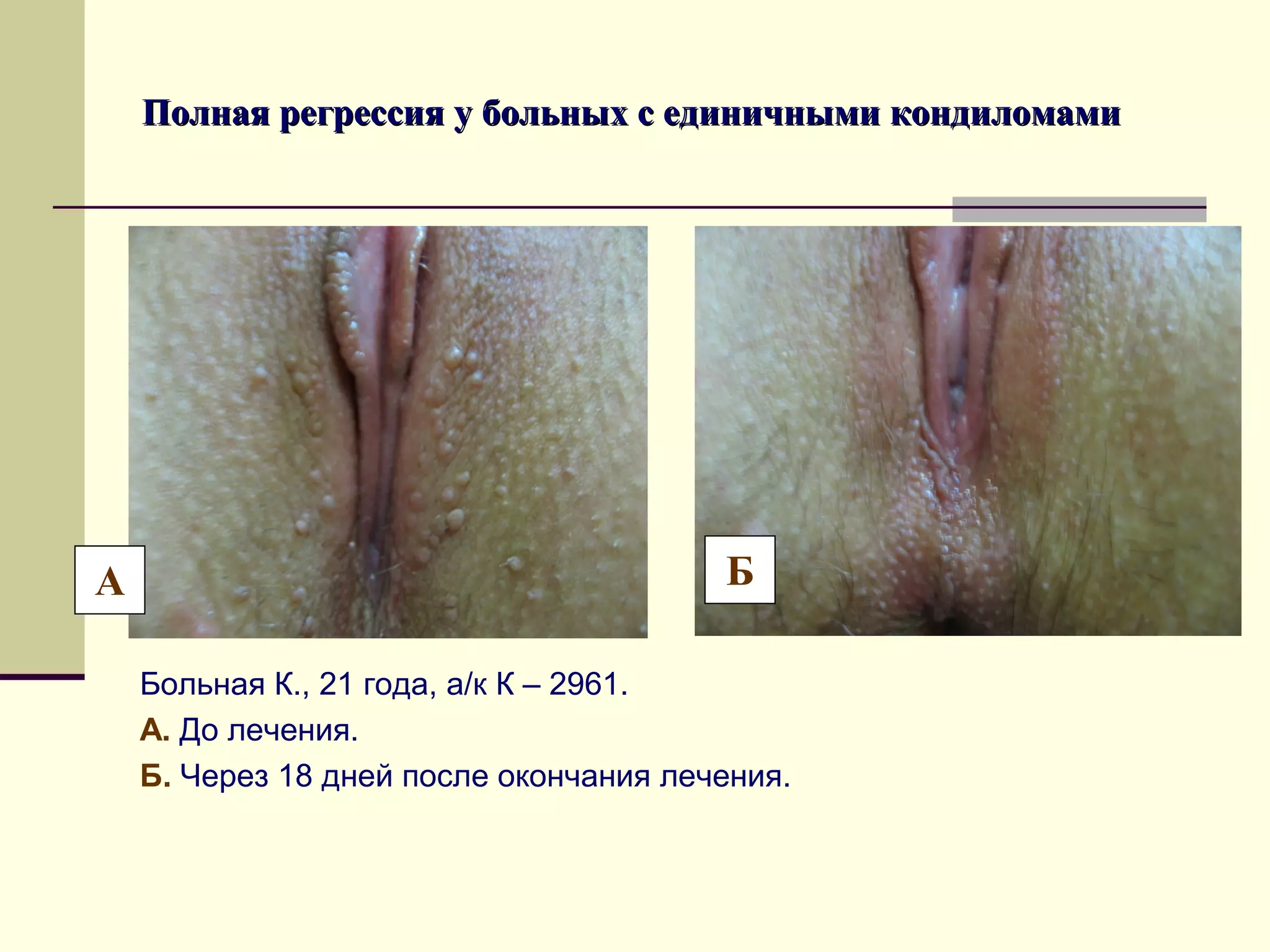 Полная регрессия у больных с единичными кондиломами




А                                       Б

    Больная К., 21 года, а/к К – 2961.
    А. До лечения.
    Б. Через 18 дней после окончания лечения.
 