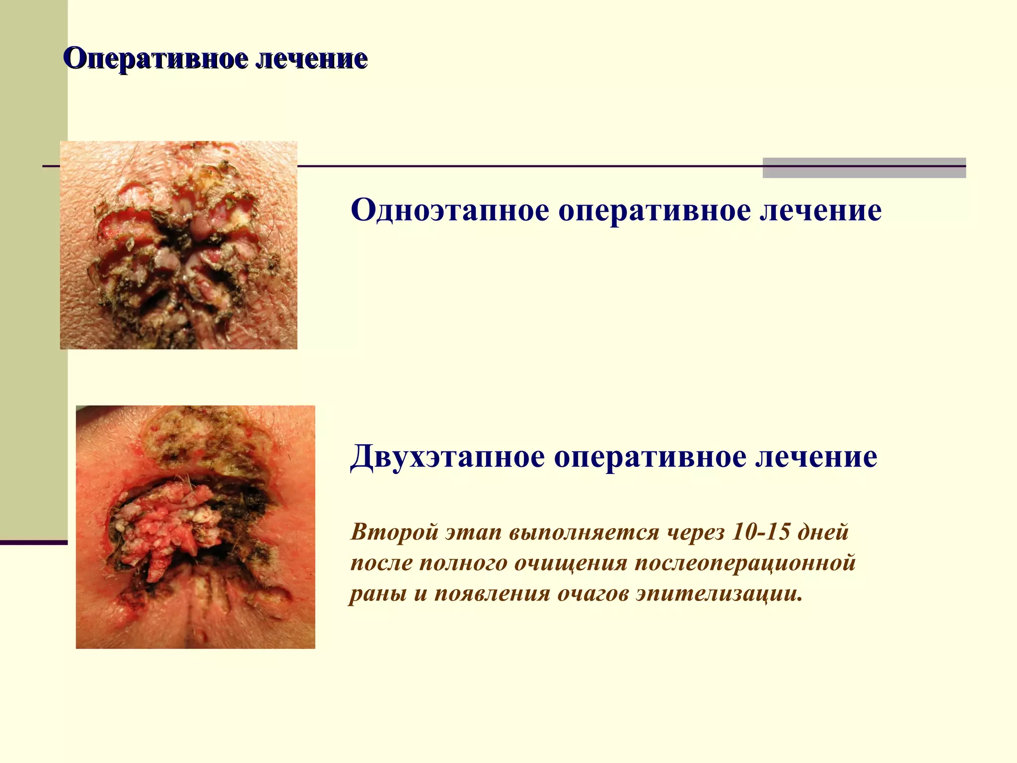 Оперативное лечение



                 Одноэтапное оперативное лечение




                 Двухэтапное оперативное лечение

                 Второй этап выполняется через 10-15 дней
                 после полного очищения послеоперационной
                 раны и появления очагов эпителизации.
 