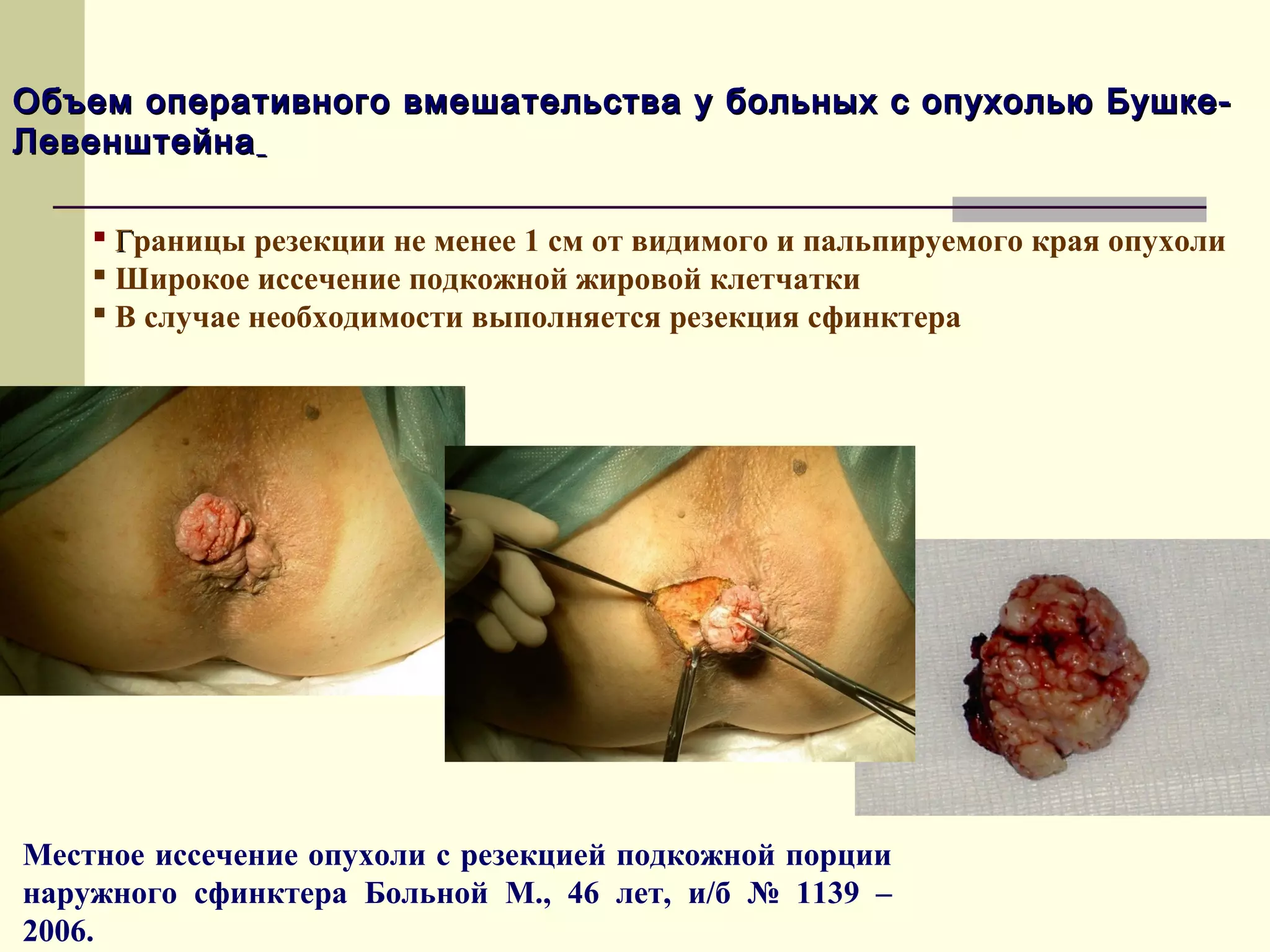 Объем оперативного вмешательства у больных с опухолью Бушке-
Левенштейна

     Границы резекции не менее 1 см от видимого и пальпируемого края опухоли
     Широкое иссечение подкожной жировой клетчатки
     В случае необходимости выполняется резекция сфинктера




Местное иссечение опухоли с резекцией подкожной порции
наружного сфинктера Больной М., 46 лет, и/б № 1139 –
2006.
 