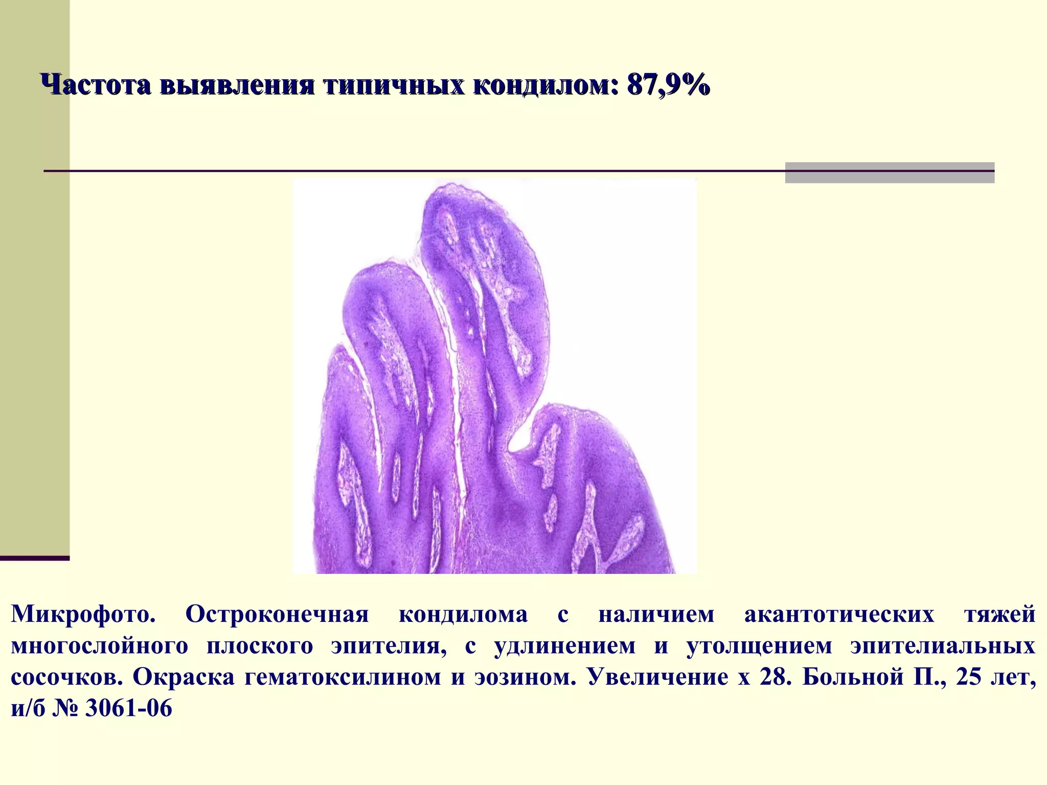 Частота выявления типичных кондилом: 87,9%




Микрофото. Остроконечная кондилома с наличием акантотических тяжей
многослойного плоского эпителия, с удлинением и утолщением эпителиальных
сосочков. Окраска гематоксилином и эозином. Увеличение х 28. Больной П., 25 лет,
и/б № 3061-06
 