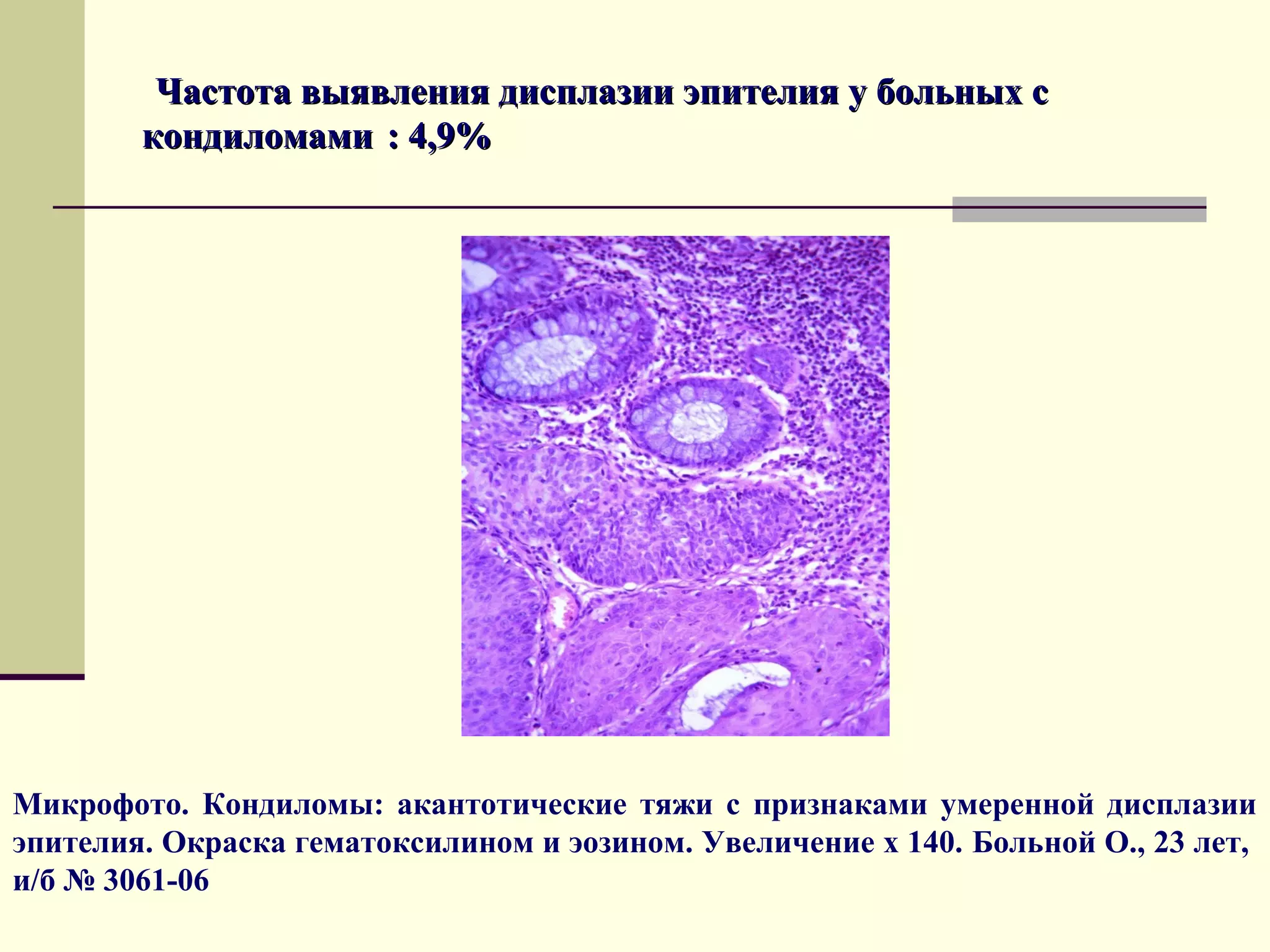Частота выявления дисплазии эпителия у больных с
        кондиломами : 4,9%




Микрофото. Кондиломы: акантотические тяжи с признаками умеренной дисплазии
эпителия. Окраска гематоксилином и эозином. Увеличение х 140. Больной О., 23 лет,
и/б № 3061-06
 