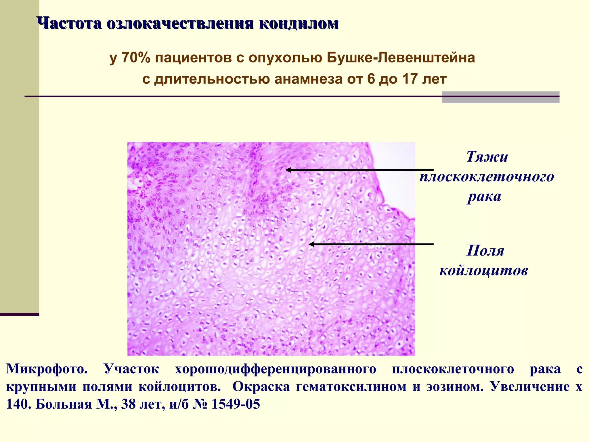Частота озлокачествления кондилом
             у 70% пациентов с опухолью Бушке-Левенштейна
                 с длительностью анамнеза от 6 до 17 лет




                                                           Тяжи
                                                     плоскоклеточного
                                                           рака


                                                          Поля
                                                       койлоцитов




Микрофото. Участок хорошодифференцированного плоскоклеточного рака с
крупными полями койлоцитов. Окраска гематоксилином и эозином. Увеличение х
140. Больная М., 38 лет, и/б № 1549-05
 