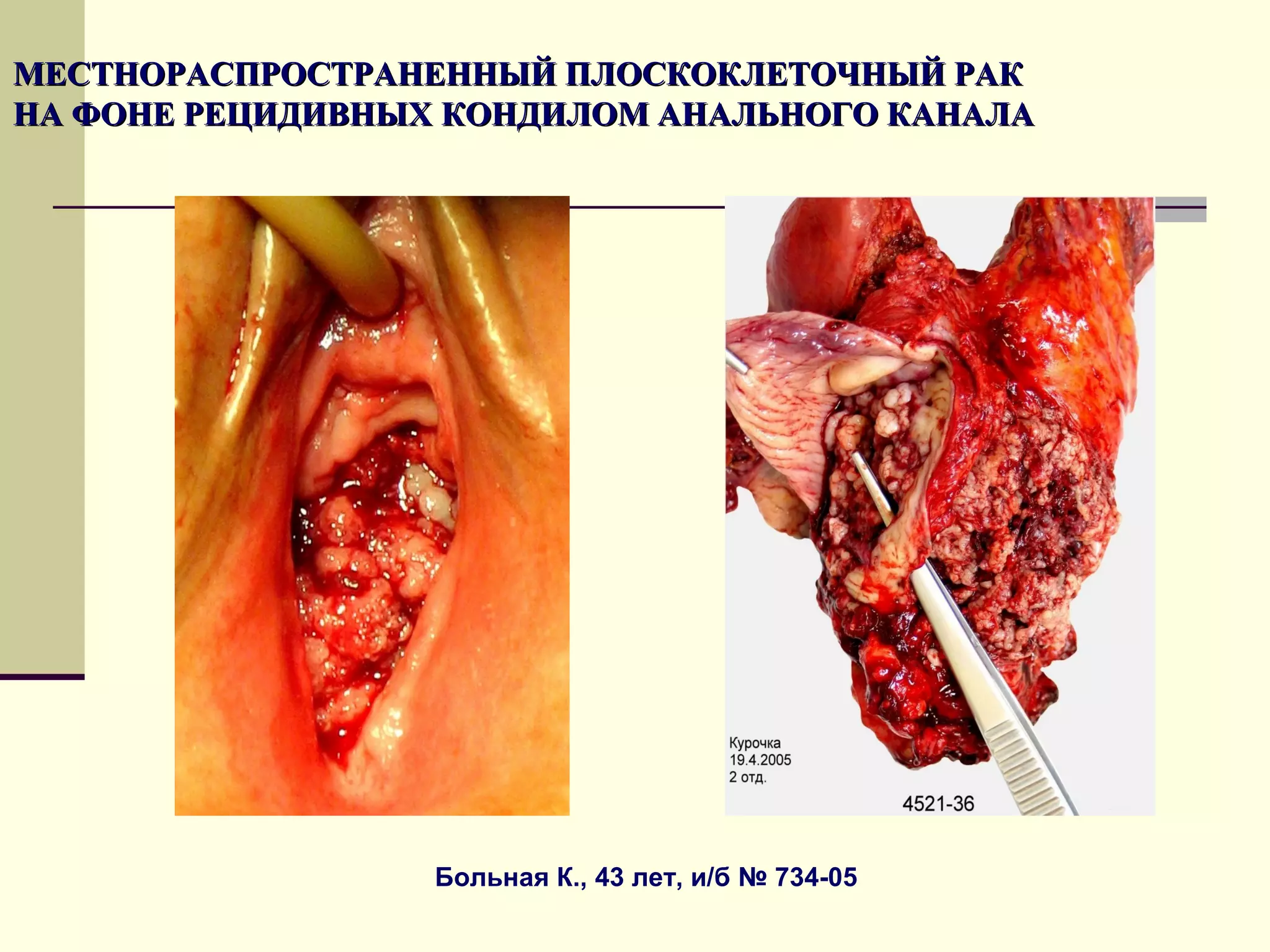 МЕСТНОРАСПРОСТРАНЕННЫЙ ПЛОСКОКЛЕТОЧНЫЙ РАК
НА ФОНЕ РЕЦИДИВНЫХ КОНДИЛОМ АНАЛЬНОГО КАНАЛА




                  Больная К., 43 лет, и/б № 734-05
 