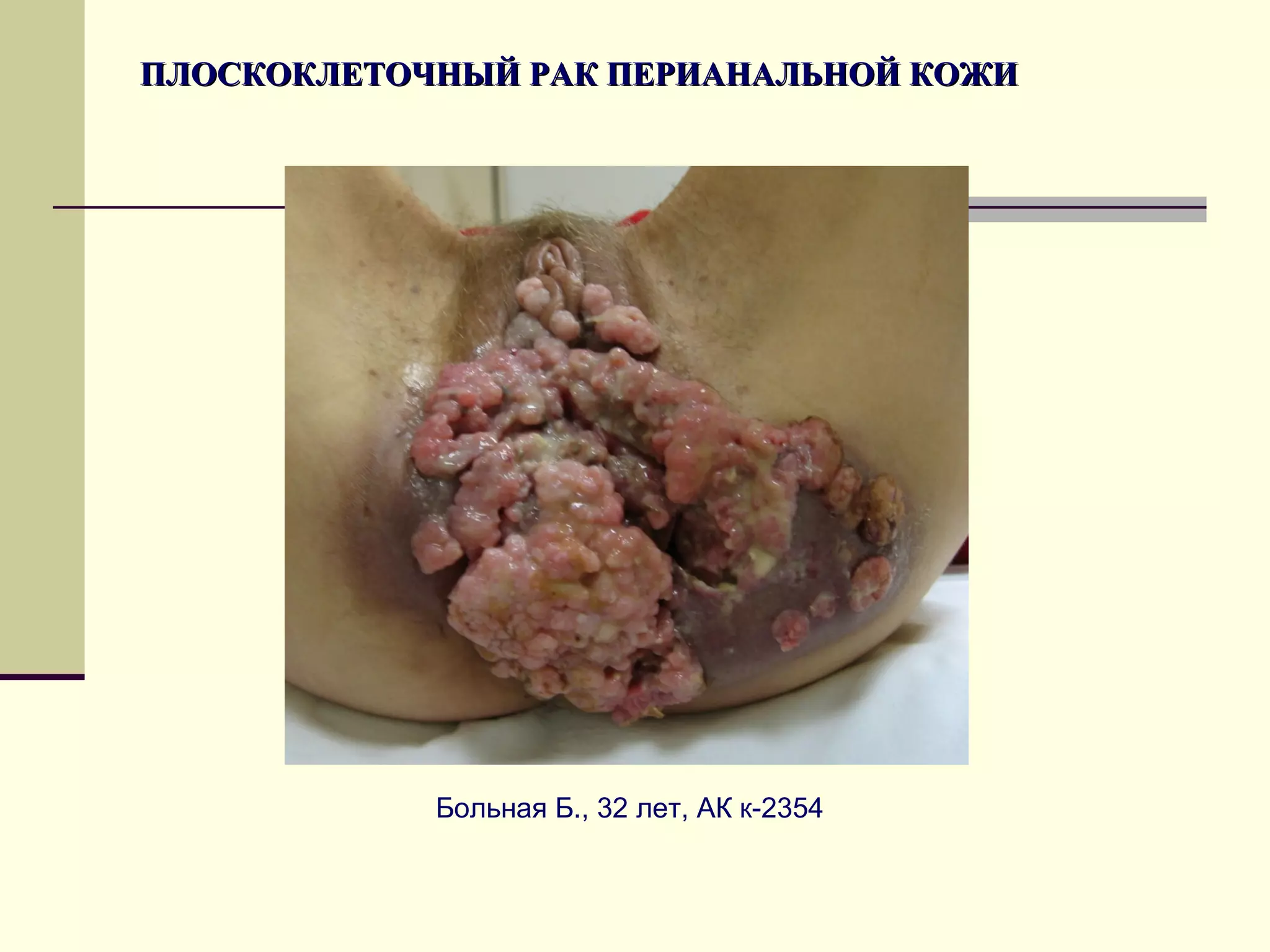 ПЛОСКОКЛЕТОЧНЫЙ РАК ПЕРИАНАЛЬНОЙ КОЖИ




            Больная Б., 32 лет, АК к-2354
 