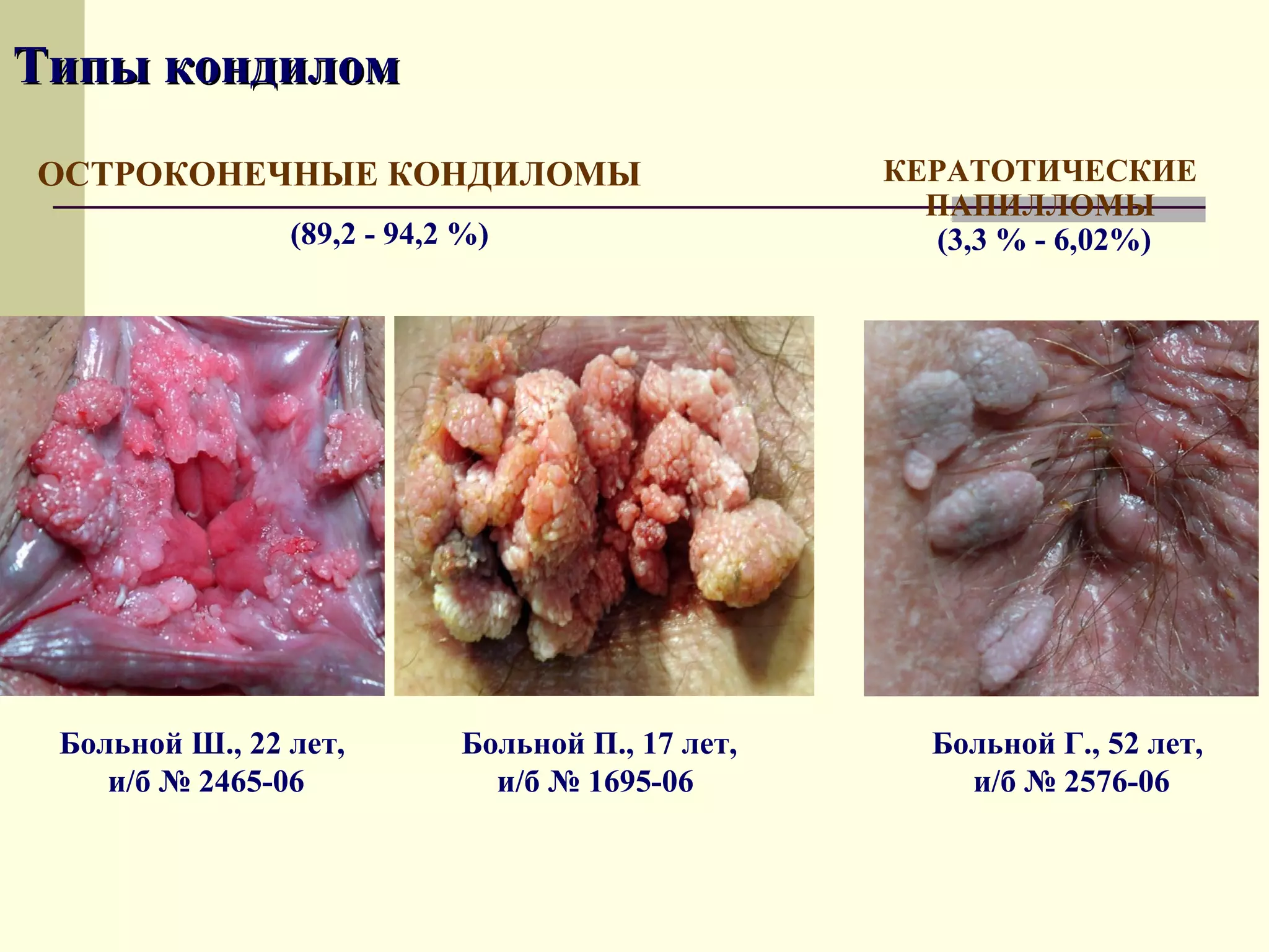 Типы кондилом
ОСТРОКОНЕЧНЫЕ КОНДИЛОМЫ                           КЕРАТОТИЧЕСКИЕ
                                                    ПАПИЛЛОМЫ
                (89,2 - 94,2 %)                      (3,3 % - 6,02%)




 Больной Ш., 22 лет,        Больной П., 17 лет,     Больной Г., 52 лет,
    и/б № 2465-06             и/б № 1695-06           и/б № 2576-06
 