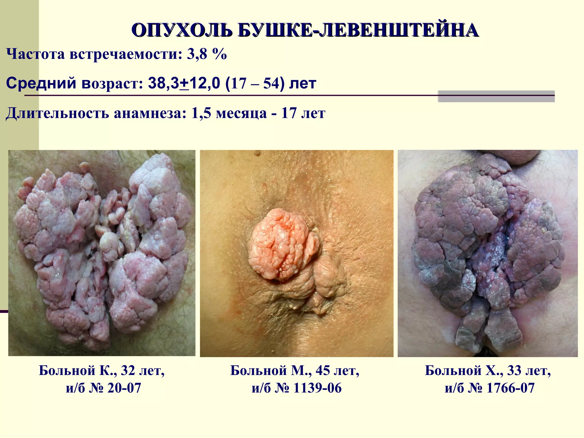 ОПУХОЛЬ БУШКЕ-ЛЕВЕНШТЕЙНА
Частота встречаемости: 3,8 %
Средний возраст: 38,3+12,0 (17 – 54) лет
Длительность анамнеза: 1,5 месяца - 17 лет




    Больной К., 32 лет,        Больной М., 45 лет,   Больной Х., 33 лет,
       и/б № 20-07                и/б № 1139-06        и/б № 1766-07
 