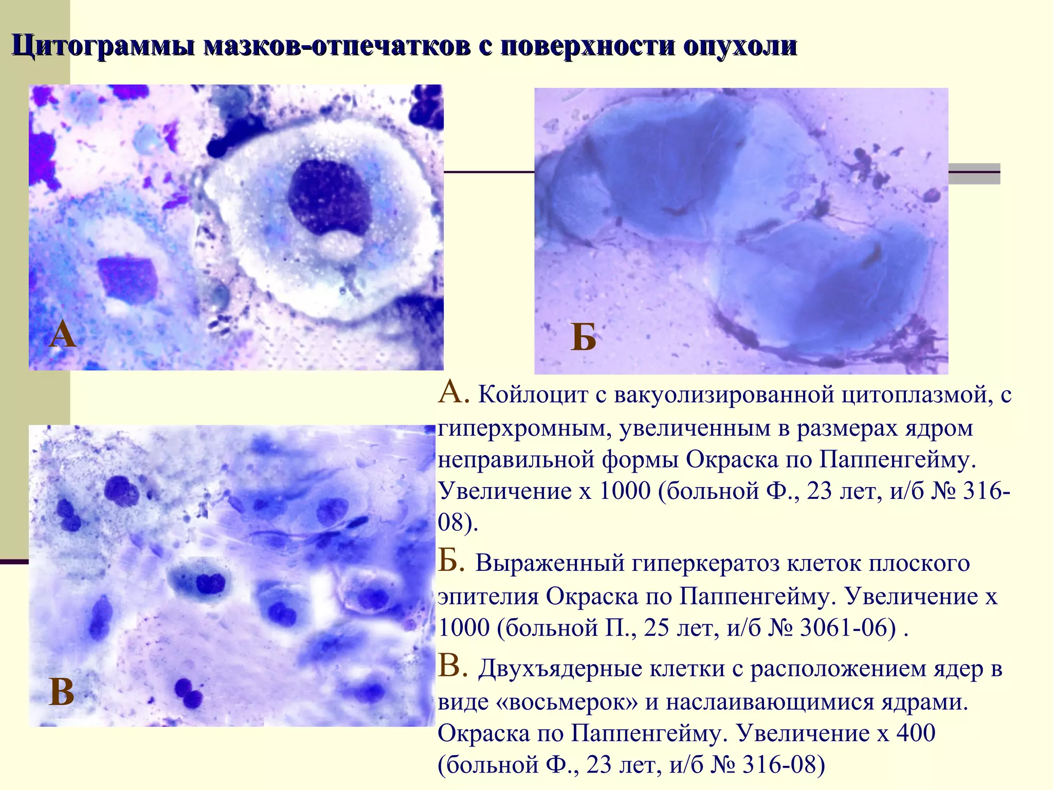 Цитограммы мазков-отпечатков с поверхности опухоли




  А                                   Б
                           А. Койлоцит с вакуолизированной цитоплазмой, с
                           гиперхромным, увеличенным в размерах ядром
                           неправильной формы Окраска по Паппенгейму.
                           Увеличение х 1000 (больной Ф., 23 лет, и/б № 316-
                           08).
                           Б. Выраженный гиперкератоз клеток плоского
                           эпителия Окраска по Паппенгейму. Увеличение х
                           1000 (больной П., 25 лет, и/б № 3061-06) .
                           В. Двухъядерные клетки с расположением ядер в
  В                        виде «восьмерок» и наслаивающимися ядрами.
                           Окраска по Паппенгейму. Увеличение х 400
                           (больной Ф., 23 лет, и/б № 316-08)
 