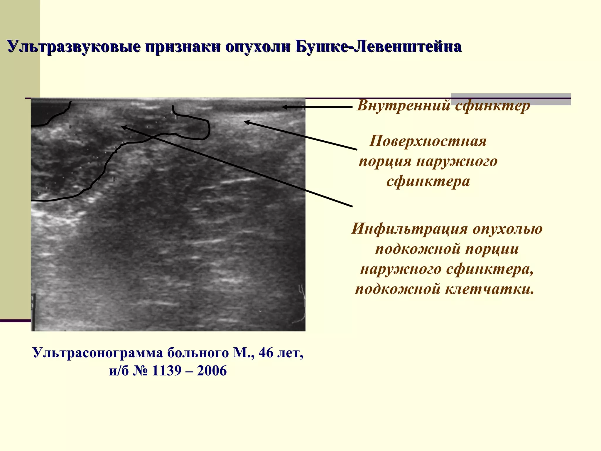 Ультразвуковые признаки опухоли Бушке-Левенштейна


                                          Внутренний сфинктер

                                           Поверхностная
                                          порция наружного
                                             сфинктера

                                          Инфильтрация опухолью
                                             подкожной порции
                                           наружного сфинктера,
                                          подкожной клетчатки.


  Ультрасонограмма больного М., 46 лет,
           и/б № 1139 – 2006
 