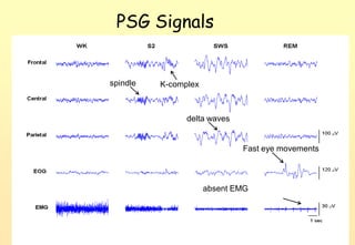 PSG Signals


spindle   K-complex



                delta waves


                              Fast eye movements



                      absent EMG




                              NCKU \cXC挍
 