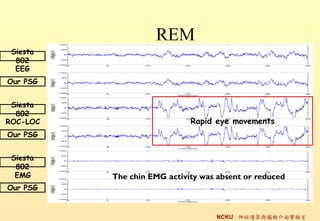 REM
 Siesta
  802
  EEG
Our PSG


 Siesta
  802
ROC-LOC                      Rapid eye movements
Our PSG


 Siesta
  802
  EMG     The chin EMG activity was absent or reduced
Our PSG


                                   NCKU \cXC挍
 