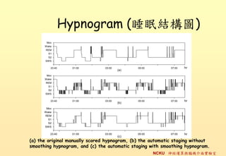 Hypnogram (˯߽YD)
       Mov
      Wake
      REM
        S1
        S2
      SWS

         23:40    01:00         03:00         05:00         07:00   hr
                                        (a)
       Mov
      Wake
      REM
        S1
        S2
      SWS

         23:40    01:00         03:00         05:00         07:00   hr
                                        (b)
       Mov
      Wake
      REM
        S1
        S2
      SWS

         23:40    01:00         03:00         05:00         07:00   hr
                                        (c)
(a) the original manually scored hypnogram, (b) the automatic staging without
smoothing hypnogram, and (c) the automatic staging with smoothing hypnogram.
                                                      NCKU \cXC挍
 