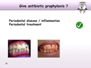 אנטיביוטיקה פרופילקטית למניעת זיהומי מפרקים מלאכותיים אורתופדיים בעקבות טיפול שיניים