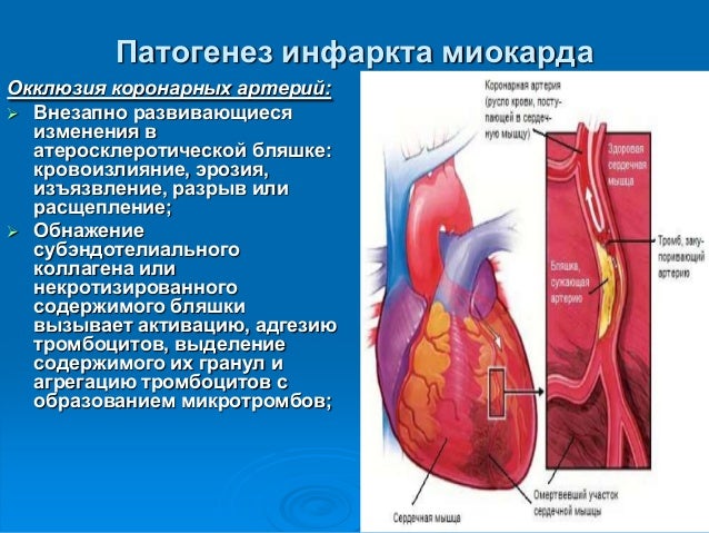 Миокард схема. Этиология инфаркта миокарда. Патогенез инфаркта миокарда. Патогенез инфаркта почки. Поражение клапанного аппарата сердца и магистральных сосудов.