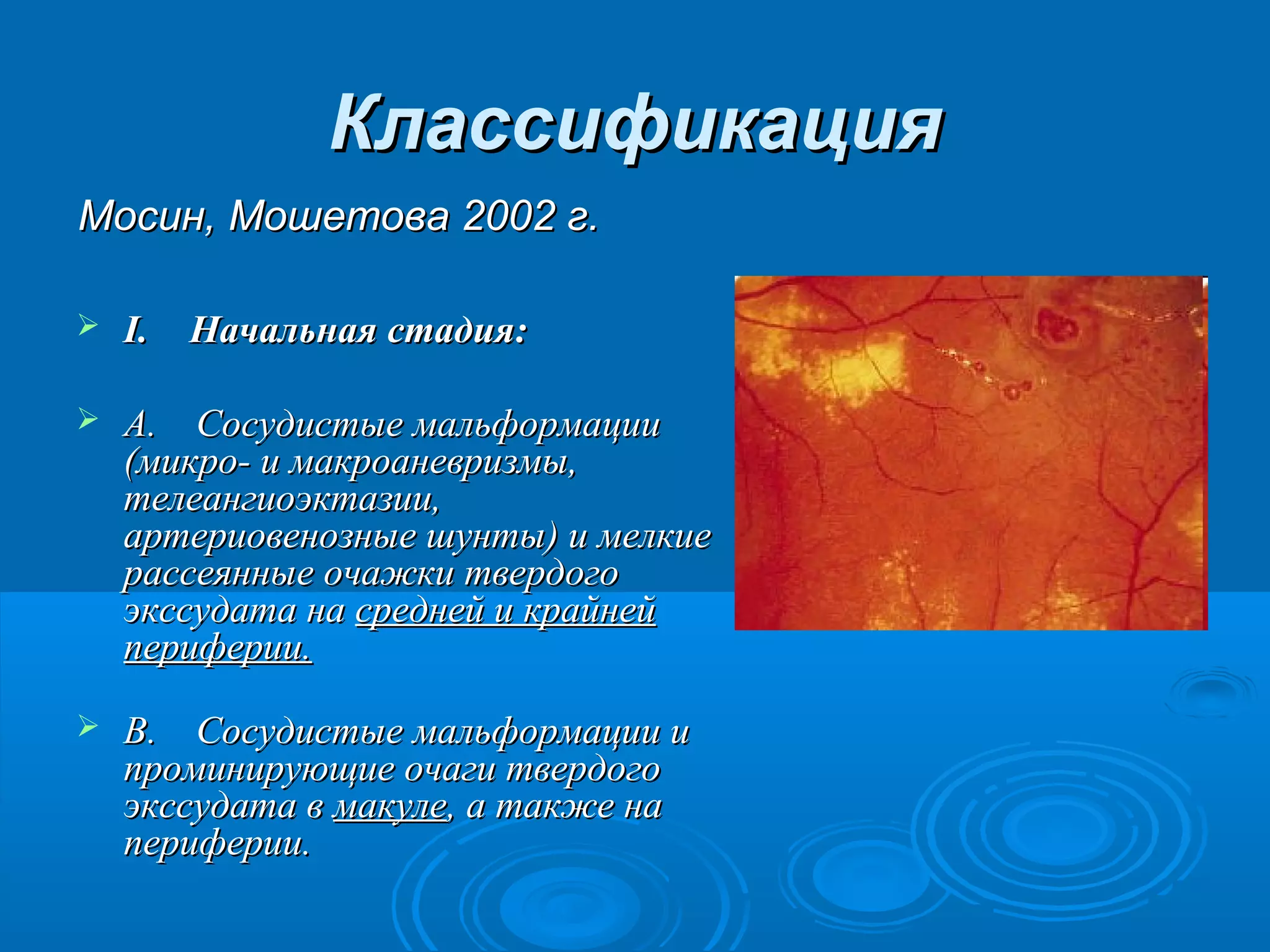 Классификация
Мосин, Мошетова 2002 г.

   I.    Начальная стадия:

   A.    Сосудистые мальформации 
    (микро- и макроаневризмы, 
    телеангиоэктазии, 
    артериовенозные шунты) и мелкие 
    рассеянные очажки твердого 
    экссудата на средней и крайней 
    периферии.

   B.    Сосудистые мальформации и 
    проминирующие очаги твердого 
    экссудата в макуле, а также на 
    периферии.
 