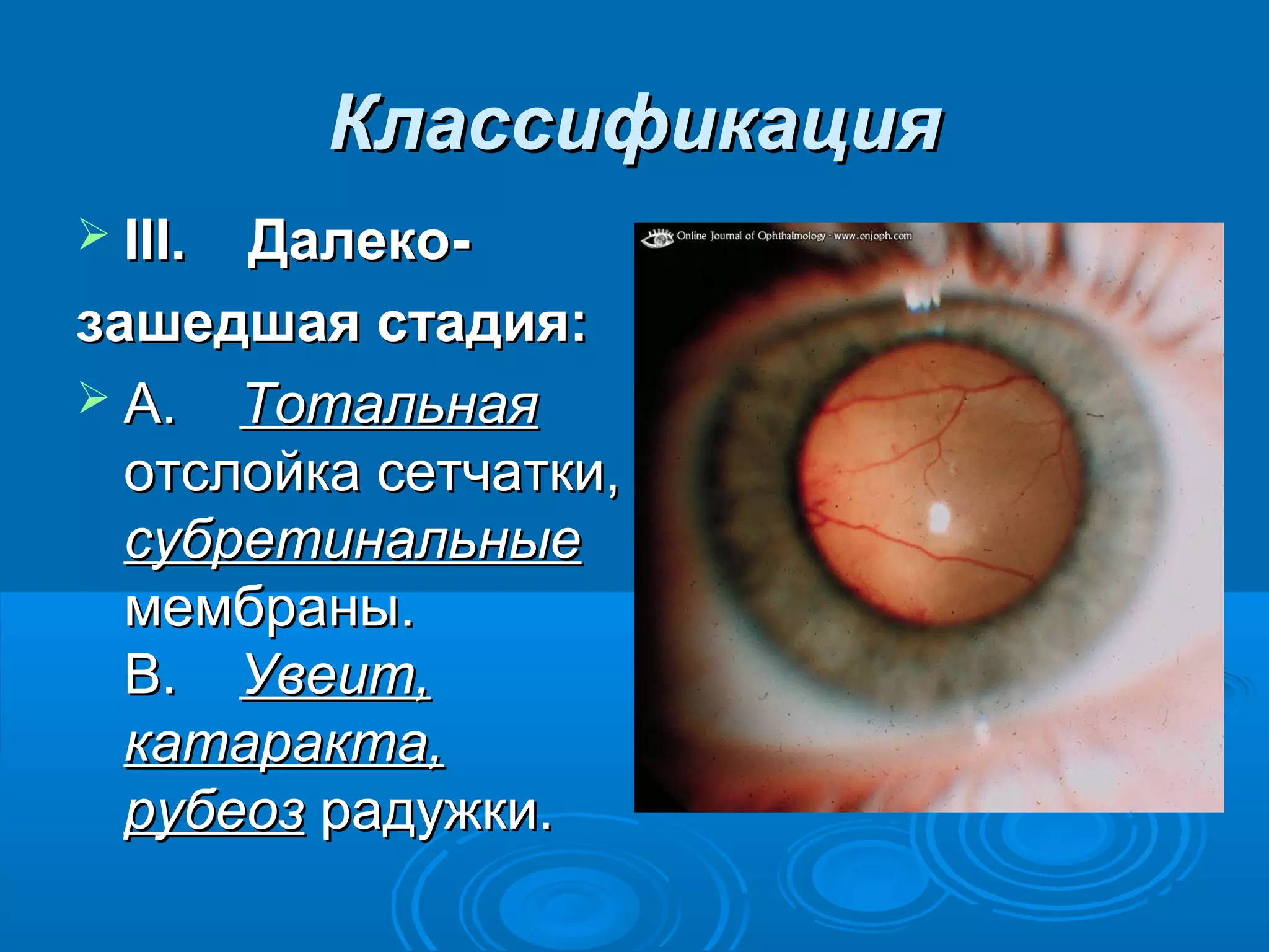Классификация
 III.    Далеко-

зашедшая стадия:
 A. Тотальная
  отслойка сетчатки,
  субретинальные
  мембраны.
  B. Увеит,
  катаракта,
  рубеоз радужки.
 