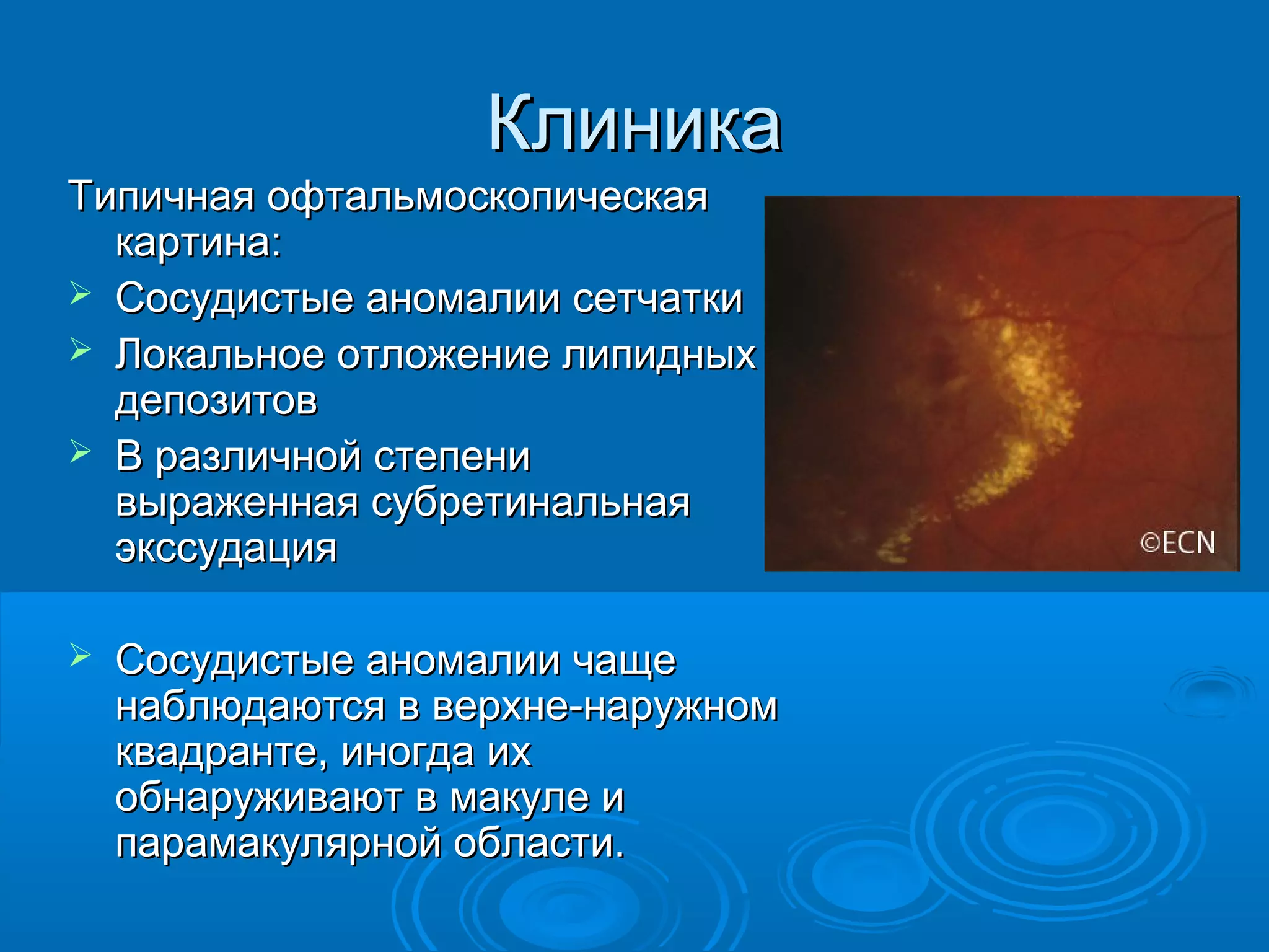 Клиника
Типичная офтальмоскопическая
  картина:
 Сосудистые аномалии сетчатки
 Локальное отложение липидных
  депозитов
 В различной степени
  выраженная субретинальная
  экссудация

   Сосудистые аномалии чаще
    наблюдаются в верхне-наружном
    квадранте, иногда их
    обнаруживают в макуле и
    парамакулярной области.
 