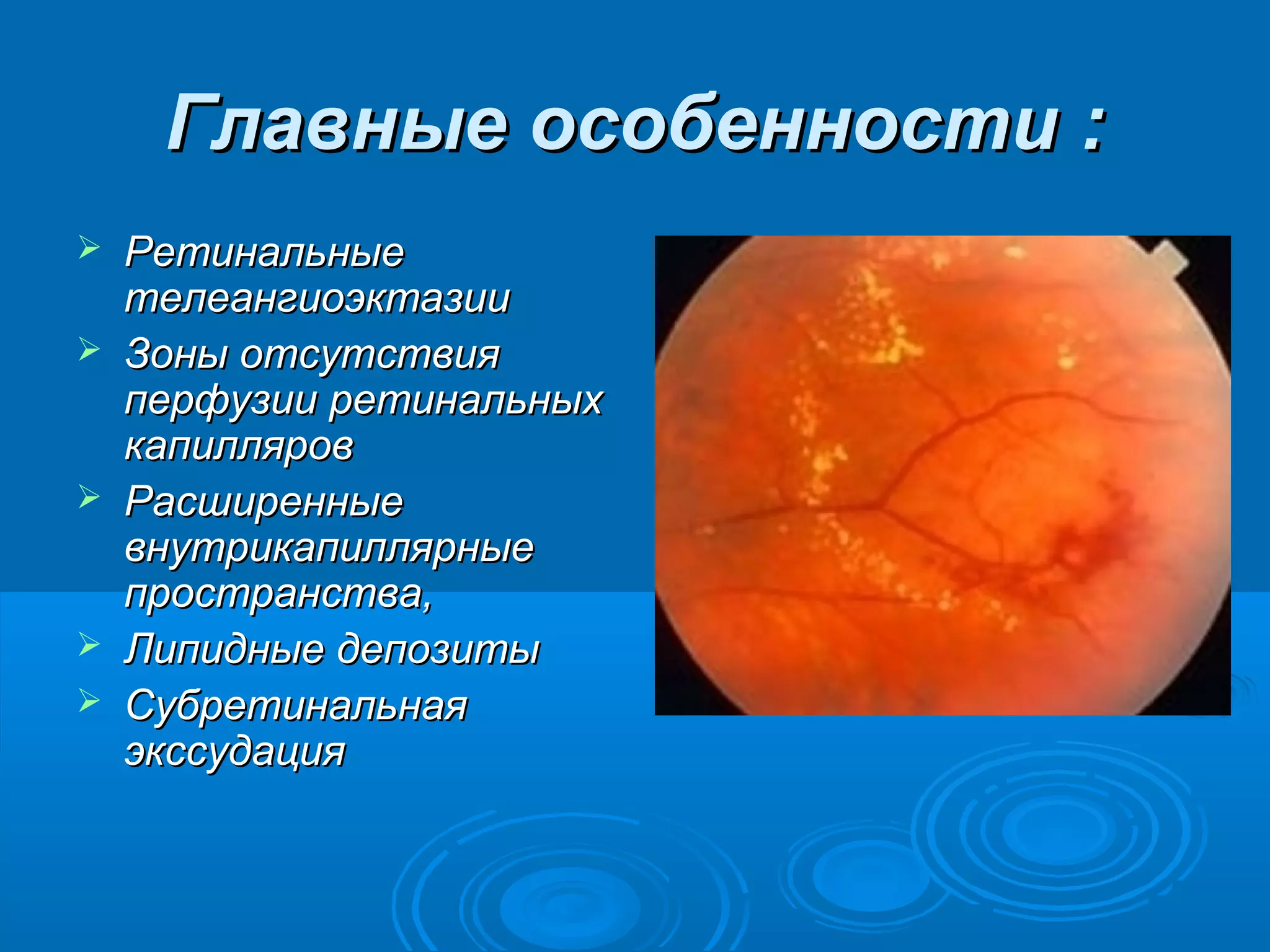Главные особенности :
   Ретинальные
    телеангиоэктазии
   Зоны отсутствия
    перфузии ретинальных
    капилляров
   Расширенные
    внутрикапиллярные
    пространства,
   Липидные депозиты
   Субретинальная
    экссудация
 