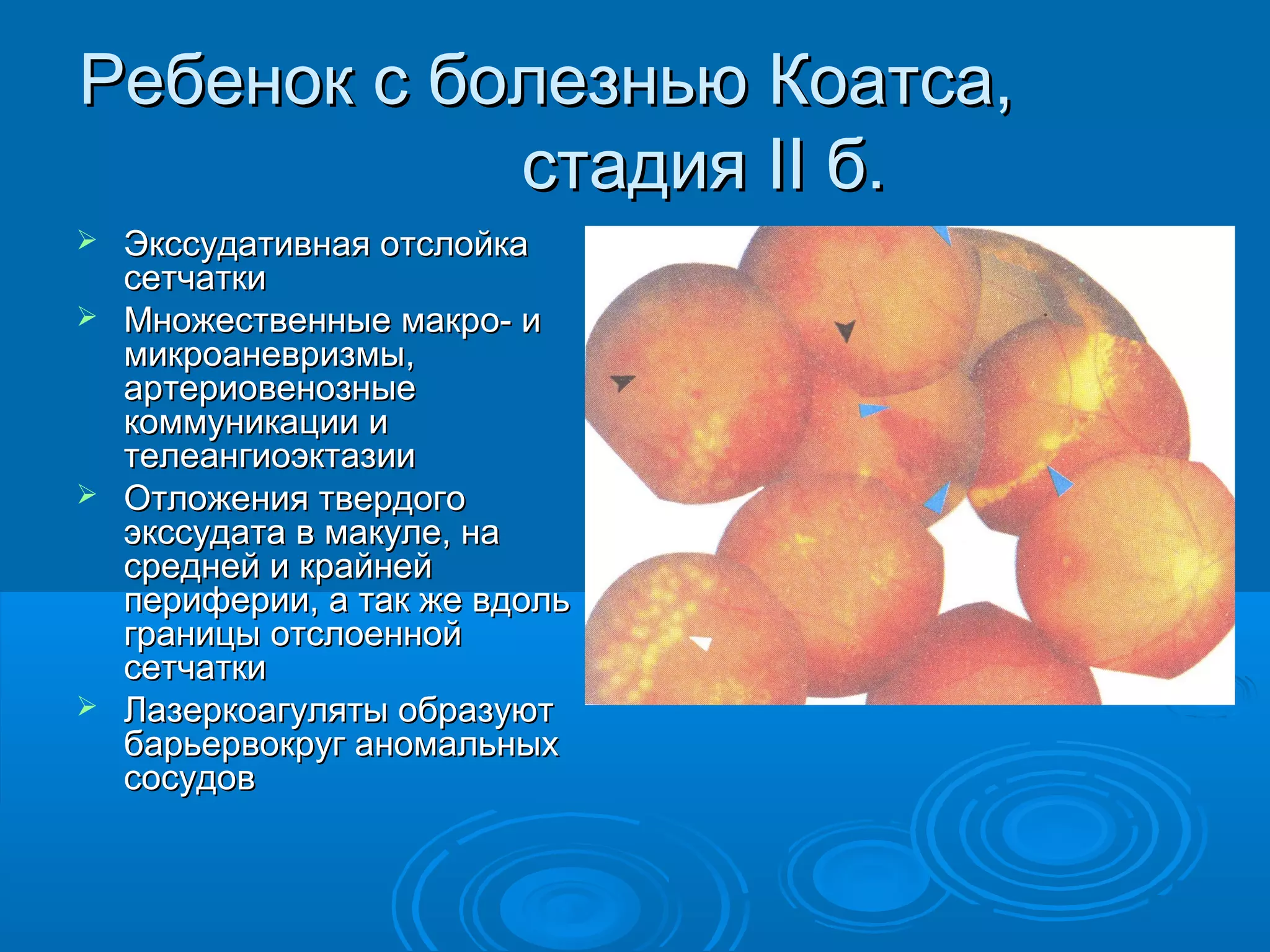 Ребенок с болезнью Коатса,
            стадия II б.
 Экссудативная отслойка
  сетчатки
 Множественные макро- и
  микроаневризмы,
  артериовенозные
  коммуникации и
  телеангиоэктазии
 Отложения твердого
  экссудата в макуле, на
  средней и крайней
  периферии, а так же вдоль
  границы отслоенной
  сетчатки
 Лазеркоагуляты образуют
  барьервокруг аномальных
  сосудов
 