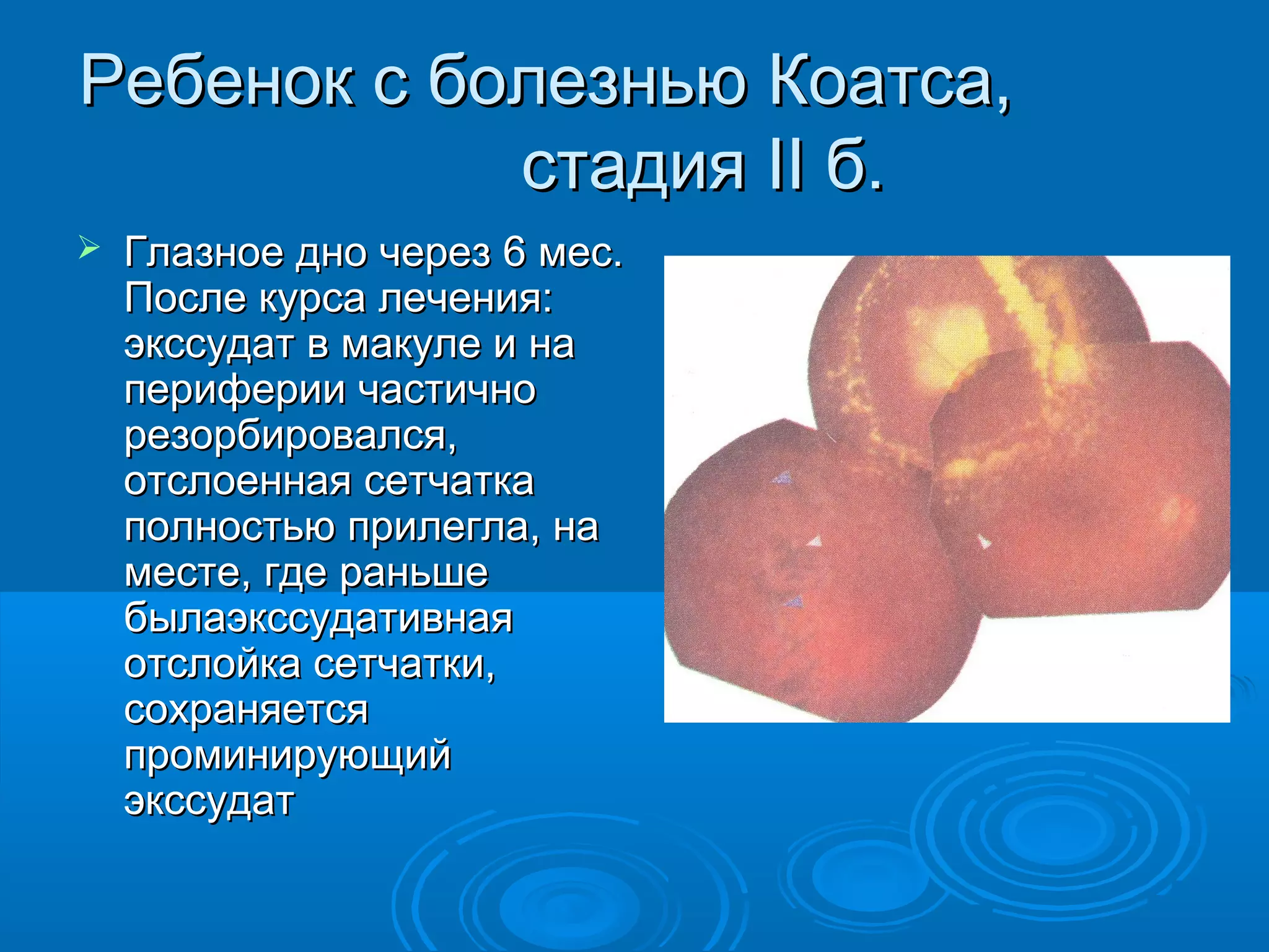 Ребенок с болезнью Коатса,
            стадия II б.
   Глазное дно через 6 мес.
    После курса лечения:
    экссудат в макуле и на
    периферии частично
    резорбировался,
    отслоенная сетчатка
    полностью прилегла, на
    месте, где раньше
    былаэкссудативная
    отслойка сетчатки,
    сохраняется
    проминирующий
    экссудат
 