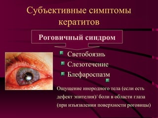 Субъективные симптомы
      кератитов
  Роговичный синдром

          Светобоязнь
          Слезотечение
          Блефароспазм
      Ощущение инородного тела (если есть
      дефект эпителия)/ боли в области глаза
      (при изъязвлении поверхности роговицы)
 
