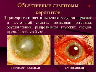 Объективные симптомы
            кератитов
Перикорнеальная инъекция сосудов – ранний
 и постоянный симптом воспаления роговицы,
 обусловленный раздражением глубоких сосудов
 краевой петлистой сети.




   ПЕРИКОРНЕАЛЬНАЯ            СМЕШАННАЯ
 