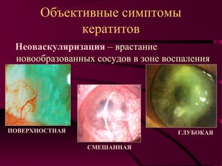 Объективные симптомы
             кератитов
 Неоваскуляризация – врастание
 новообразованных сосудов в зоне воспаления




ПОВЕРХНОСТНАЯ                       ГЛУБОКАЯ

                СМЕШАННАЯ
 