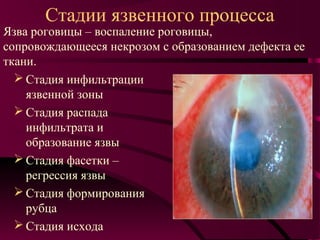 Стадии язвенного процесса
Язва роговицы – воспаление роговицы,
сопровождающееся некрозом с образованием дефекта ее
ткани.
   Стадия инфильтрации
    язвенной зоны
   Стадия распада
    инфильтрата и
    образование язвы
   Стадия фасетки –
    регрессия язвы
   Стадия формирования
    рубца
   Стадия исхода
 
