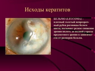 Исходы кератитов
          БЕЛЬМО (LEUCOMA) –
          плотный толстый непрозрач-
          ный рубец роговицы белого
          цвета, вызывает резкое снижение
          зрения вплоть до полной утраты
          предметного зрения в зависимо-
          сти от размеров бельма.
 
