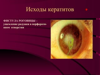 Исходы кератитов
ФИСТУЛА РОГОВИЦЫ –
ущемление радужки в перфорати-
вном отверстии
 