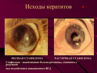 Исходы кератитов




    ПОЛНАЯ СТАФИЛОМА               ЧАСТИЧНАЯ СТАФИЛОМА
Стафилома – выпячивание бельма роговицы, спаянного с
радужкой
под воздействием повышенного ВГД
 