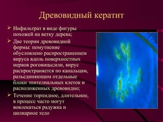 Древовидный кератит
 Инфильтрат в виде фигуры
  похожей на ветку дерева;
 Две теории древовидной
  формы: помутнение
  обусловлено распространением
  вируса вдоль поверхностных
  нервов роговицы;или, вирус
  распространяется по канальцам,
  разъединяющим отдельные
  блоки эпителиальных клеток и
  расположенных древовидно;
 Течение торпидное, длительное,
  в процесс часто могут
  вовлекаться радужка и
  цилиарное тело
 