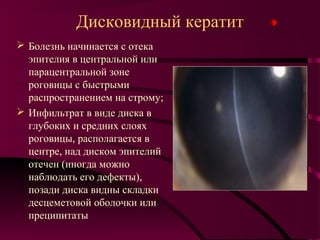 Дисковидный кератит
 Болезнь начинается с отека
  эпителия в центральной или
  парацентральной зоне
  роговицы с быстрыми
  распространением на строму;
 Инфильтрат в виде диска в
  глубоких и средних слоях
  роговицы, располагается в
  центре, над диском эпителий
  отечен (иногда можно
  наблюдать его дефекты),
  позади диска видны складки
  десцеметовой оболочки или
  преципитаты
 