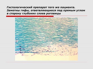 Гистологический препарат того же пациента.
Заметны гифы, ответвляющиеся под прямым углом
в сторону глубоких слоев роговицы
 
