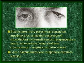 В конечном итоге растянутая слизистая
атрофируется, лишается секреторной
способности и слезный мешок превращается в
кисту, заполненную чаще гнойным
содержимым – водянка слезного мешка
( син.: дакриоцистоцеле, гидроцеле слезного
мешка)
 