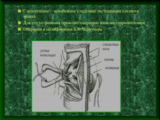 Слезотечение – неизбежное следствие экстирпации слезного
мешка
Для его устранения проводят операцию каналикулориностомии
Операция в модификации Б.Ф.Черкунова
 