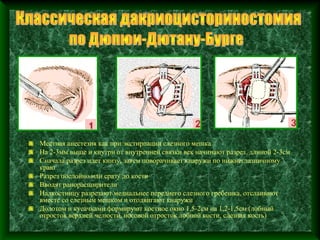 Местная анестезия как при экстирпации слезного мешка
На 2-3мм выше и кнутри от внутренней связки век начинают разрез длиной 2-3см
Сначала разрез идет книзу, затем поворачивает кнаружи по нижнеглазничному
краю
Разрез послойно или сразу до кости
Вводят ранорасширители
Надкостницу разрезают медиальнее переднего слезного гребешка, отслаивают
вместе со слезным мешком и отодвигают кнаружи
Долотом и кусачками формируют костное окно 1,5-2см на 1,2-1,5см (лобный
отросток верхней челюсти, носовой отросток лобной кости, слезная кость)
 