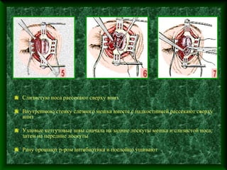 Слизистую носа рассекают сверху вниз

Внутреннюю стенку слезного мешка вместе с надкостницей рассекают сверху
вниз

Узловые кетгутовые швы сначала на задние лоскуты мешка и слизистой носа,
затем на передние лоскуты

Рану орошают р-ром антибиотика и послойно ушивают
 