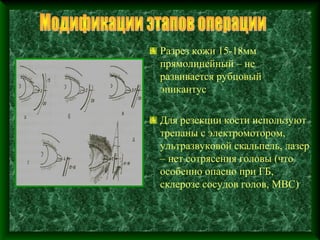 Разрез кожи 15-18мм
прямолинейный – не
развивается рубцовый
эпикантус

Для резекции кости используют
трепаны с электромотором,
ультразвуковой скальпель, лазер
– нет сотрясения головы (что
особенно опасно при ГБ,
склерозе сосудов голов, МВС)
 