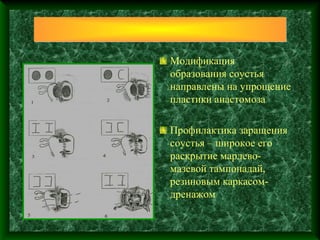 Модификация
образования соустья
направлены на упрощение
пластики анастомоза

Профилактика заращения
соустья – широкое его
раскрытие марлево-
мазевой тампонадай,
резиновым каркасом-
дренажом
 