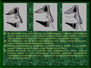 На боковой стенке носа, впереди средней раковины, удаляют ромбовидный
лоскут слизистой носа соответственно размерам слезной ямки. Кпереди от этого
дефекта образуют П-образный лоскут слизистой и откладывают его вниз.
Желобовидным долотом Веста продалбливают кость вокруг торчащего кончика
зонда, а затем кусачками расширяют отверстие.
Вертикальным разрезом вскрывают полость слезного мешка и конхотомом
удаляют его внутреннюю стенку в пределах костного окна.
Откинутый книзу лоскут слизистой носа возвращают на место, полость
слезного мешка и носа тампонируют марлевой турундой, пропитанной
стерильным вазелиновым маслом с добавлением мази из антибиотиков. Через 4
дня турунду извлекают.
 